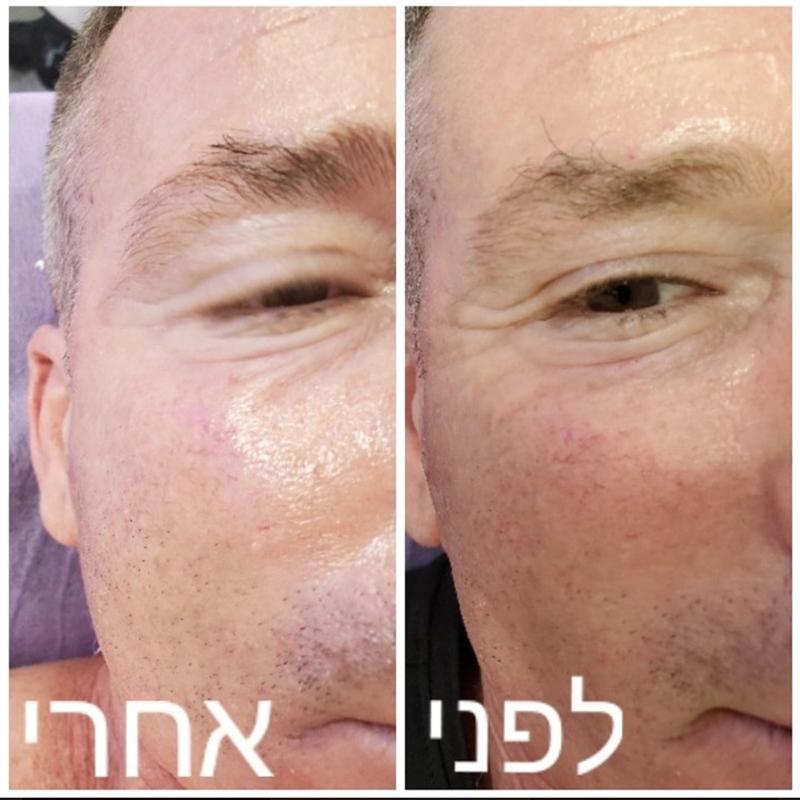 הסרת פיגמנטציה