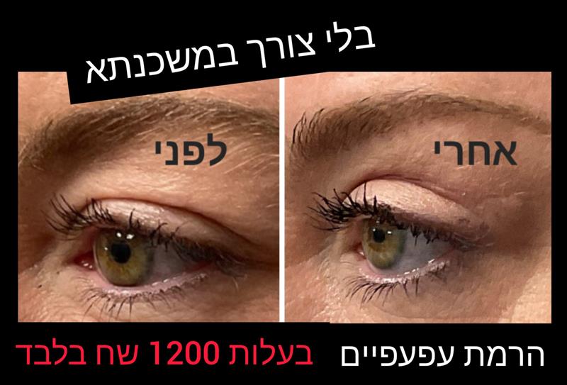 הרמת עפעפיים